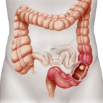 colonoscopy